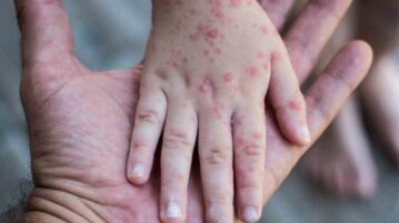 There are 13 cases of monkeypox in Jalisco