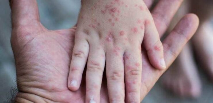 There are 13 cases of monkeypox in Jalisco