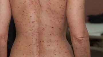 156 cases of monkeypox in Jalisco