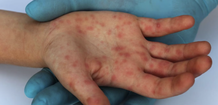 Jalisco reports no active cases of Mpox in the last week