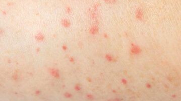 Jalisco ends 2025 with more than 500 measles cases