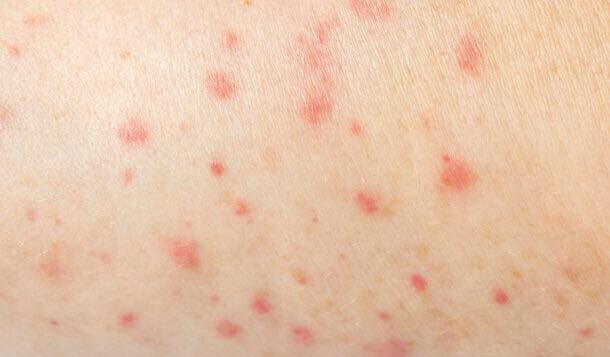 Jalisco ends 2025 with more than 500 measles cases